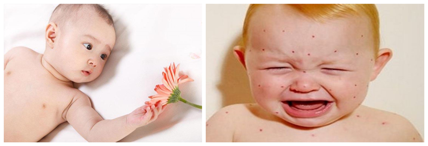 兒童濕疹反反復復，您有在家安裝家用除濕產(chǎn)品嗎？